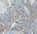 HSP47 Antibody Human Esophageal Squamous Carcinoma IHC. HSP47 Antibody was used for immunohistochemical staining of FFPE human esophageal squamous carcinoma tissue following heat-induced epitope retrieval in pH 8 EDTA buffer. The section was incubated with the primary antibody at 2 ug/ml, followed by an HRP-conjugated goat anti-rabbit secondary antibody and DAB chromogen for detection. Moderate to strong cytoplasmic staining is observed within malignant squamous epithelial cells and the surrounding stromal compartment, consistent with the expression pattern of the collagen-specific chaperone SERPINH1 during extracellular matrix remodeling. This HSP47 Antibody, a Collagen Chaperone Antibody, is useful for studying collagen biosynthesis, tumor-associated fibrosis, and stromal remodeling in esophageal cancer.