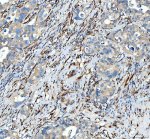 HSP47 Antibody Human Appendiceal Adenocarcinoma IHC. HSP47 Antibody was used for immunohistochemical staining of FFPE human appendiceal adenocarcinoma tissue following heat-induced epitope retrieval in pH 8 EDTA buffer. The section was incubated with the primary antibody at 2 ug/ml, followed by an HRP-conjugated goat anti-rabbit secondary antibody and DAB chromogen for detection. Prominent cytoplasmic staining is observed within stromal spindle-shaped cells and surrounding connective tissue, with weaker staining present in subsets of tumor cells, consistent with the role of SERPINH1 in collagen biosynthesis and extracellular matrix remodeling. This HSP47 Antibody, a Collagen Chaperone Antibody, is valuable for investigating fibrosis, collagen deposition, and stromal remodeling within the tumor microenvironment.