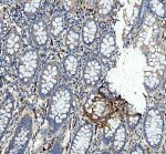 HSP47 Antibody Human Colon Cancer IHC. HSP47 Antibody was used for immunohistochemical staining of FFPE human colon cancer tissue following heat-induced epitope retrieval in pH 8 EDTA buffer. The section was incubated with the primary antibody at 2 ug/ml, followed by an HRP-conjugated goat anti-rabbit secondary antibody and DAB chromogen for detection. Predominant cytoplasmic staining is observed within stromal fibroblast-like cells surrounding the colonic glands, with comparatively weaker staining in the epithelial tumor cells, reflecting the collagen-associated expression pattern of SERPINH1 during extracellular matrix remodeling. This HSP47 Antibody, a Collagen Chaperone Antibody, is well suited for investigating collagen biosynthesis, tumor-associated fibrosis, and stromal remodeling in colorectal cancer.
