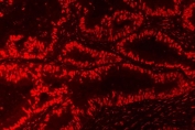 Immunofluorescent staining of FFPE human intestinal cancer tissue with Nucleophosmin antibody. HIER: steam section in pH8 EDTA for 20 min.