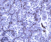 Vimentin Antibody / Tumor Microenvironment Marker Antibody Human Lung Adenocarcinoma IHC. Immunohistochemical staining of FFPE human lung adenocarcinoma tissue using Vimentin Antibody / Tumor Microenvironment Marker Antibody. Vimentin expression is observed predominantly within stromal fibroblasts, vascular elements, and other mesenchymal cells of the tumor microenvironment, consistent with its role in supporting extracellular matrix remodeling, epithelial-to-mesenchymal transition, and tumor progression. Heat-induced epitope retrieval was performed by boiling tissue sections in pH 8 EDTA for 20 minutes followed by cooling prior to immunostaining.
