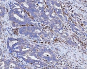 Vimentin Antibody / Tumor Microenvironment Marker Antibody Human Colorectal Adenocarcinoma IHC. Immunohistochemical staining of FFPE human colorectal adenocarcinoma tissue using Vimentin Antibody / Tumor Microenvironment Marker Antibody. Vimentin expression is observed predominantly within stromal fibroblasts and other mesenchymal cells surrounding the tumor glands, consistent with its role as a marker of the tumor microenvironment involved in extracellular matrix remodeling, stromal activation, and tumor progression. Heat-induced epitope retrieval was performed by boiling tissue sections in pH 8 EDTA for 20 minutes followed by cooling prior to immunostaining.