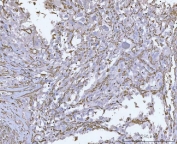 Vimentin Antibody / Tumor Microenvironment Marker Antibody Human Invasive Urothelial Carcinoma IHC. Immunohistochemical staining of FFPE human invasive urothelial carcinoma tissue using Vimentin Antibody / Tumor Microenvironment Marker Antibody. Vimentin expression is observed predominantly within stromal fibroblasts, infiltrating mesenchymal cells, and vascular elements of the tumor microenvironment, consistent with its role in extracellular matrix remodeling, epithelial-to-mesenchymal transition, and the invasive behavior of urothelial carcinoma. Heat-induced epitope retrieval was performed by boiling tissue sections in pH 8 EDTA for 20 minutes followed by cooling prior to immunostaining.