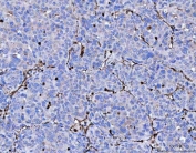 Vimentin Antibody / Tumor Microenvironment Marker Antibody Human Liver Cancer IHC. Immunohistochemical staining of FFPE human liver cancer tissue using Vimentin Antibody / Tumor Microenvironment Marker Antibody. Vimentin expression is observed predominantly within stromal fibroblasts, vascular endothelial cells, and other mesenchymal components of the tumor microenvironment, consistent with its role in extracellular matrix remodeling, angiogenesis, and support of tumor progression. Heat-induced epitope retrieval was performed by boiling tissue sections in pH 8 EDTA for 20 minutes followed by cooling prior to immunostaining.