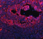 PGRMC1 Antibody Human Intestine Cancer IF. Immunofluorescent staining of FFPE human intestine cancer tissue with PGRMC1 Antibody at 5 ug/ml. HIER was performed using pH 8 EDTA buffer, followed by blocking with 10% goat serum. The tissue section was incubated with rabbit anti-PGRMC1 antibody overnight at 4Â°C, followed by Cy conjugated goat anti-rabbit IgG secondary antibody (red). Nuclei were counterstained with DAPI (blue). PGRMC1 Antibody / Progesterone Receptor Membrane Component Antibody demonstrates cytoplasmic staining and supports research into steroid signaling pathways, cancer biology and cell survival regulation.