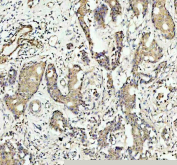 Immunohistochemistry analysis of SAPK4 in human breast cancer tissue. SAPK4 antibody was used to detect SAPK4 in paraffin-embedded human breast cancer tissue. Antigen retrieval was performed using EDTA buffer (pH 8.0). Tumor epithelial cells show cytoplasmic staining, while surrounding stromal cells display weaker signal. Detection was performed using an HRP-DAB system.