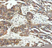 Immunohistochemistry analysis of SAPK4 in human ovary cancer tissue. SAPK4 antibody was applied to paraffin-embedded human ovary cancer tissue following EDTA-based antigen retrieval (pH 8.0). Cytoplasmic staining is observed in tumor epithelial cells with lower background in adjacent stromal regions. Signal was visualized using HRP-DAB chemistry.