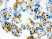 Band 3 Antibody Human Placenta Frozen IHC. Immunohistochemical staining of frozen human placenta tissue using Band 3 Antibody / Anion Exchange Protein 1 Antibody demonstrates distinct membranous and cytoplasmic staining within placental trophoblast cell populations. Band 3 (AE1/SLC4A1) is a chloride/bicarbonate exchanger that regulates transmembrane ion transport and contributes to maintenance of cellular acid-base balance and ionic homeostasis. While best known as a major erythrocyte membrane protein, AE1-related transport activity is also associated with specialized epithelial cells that require tightly regulated bicarbonate and chloride exchange. The observed trophoblast-associated staining pattern is consistent with expression of membrane transport proteins involved in placental physiology, ion balance, and cellular homeostasis.