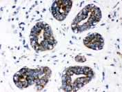 CYP1A1 Antibody Human Breast Cancer IHC. IHC staining of FFPE human breast cancer tissue with CYP1A1 antibody demonstrated strong cytoplasmic staining in malignant epithelial cells. CYP1A1 is a heme-containing cytochrome P450 monooxygenase that catalyzes Phase I xenobiotic metabolism and is induced through aryl hydrocarbon receptor (AHR) signaling following exposure to environmental toxicants. In addition to its role in chemical detoxification, CYP1A1 contributes to the metabolic activation of procarcinogens and has been implicated in tumor biology and therapeutic response. HIER was performed by boiling tissue sections in pH 6, 10 mM citrate buffer for 20 minutes followed by cooling prior to staining. These results support the utility of CYP1A1 Antibody for studies of xenobiotic metabolism, AHR signaling, environmental toxicology, and cancer research.