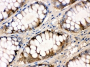 FABP Antibody Rabbit Polyclonal Intestinal Cancer IHC. Immunohistochemistry of FABP antibody in human intestinal cancer tissue. FFPE human intestinal carcinoma was stained with FABP antibody rabbit polyclonal. Predominant cytoplasmic HRP-DAB brown staining is observed in gland-forming tumor epithelial cells, consistent with Liver fatty acid binding protein expression in intestinal epithelium. Stromal cells show minimal staining. Heat induced epitope retrieval was performed by boiling paraffin sections in pH 6, 10 mM citrate buffer for 20 minutes followed by cooling prior to antibody incubation.