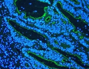 Villin Antibody for IF. Immunofluorescence analysis of Villin-1 (VIL1) in FFPE rectal cancer tissue using a VIL1 Immunofluorescence Antibody (rabbit polyclonal). Villin Antibody for IF demonstrates prominent apical membrane staining of tumor epithelial cells (green), outlining glandular structures and highlighting retained brush border-like polarity within malignant tissue, while nuclei are counterstained with DAPI (blue). The localized luminal fluorescence supports detection of epithelial differentiation patterns and is consistent with Villin expression in intestinal-type adenocarcinoma, making this antibody well suited for immunofluorescence imaging of tumor architecture and epithelial organization.