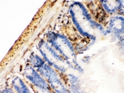 Galectin 1 Antibody Mouse Intestinal Cancer IHC. Immunohistochemical staining of FFPE mouse intestinal cancer tissue using Galectin 1 antibody demonstrates cytoplasmic and membranous HRP-DAB brown staining within neoplastic epithelial cells and adjacent stromal elements. The staining pattern is consistent with expression of Galectin-1 (LGALS1), a beta-galactoside-binding lectin involved in cell adhesion, immune regulation, extracellular matrix remodeling, angiogenesis, and tumor progression. Positive immunoreactivity is observed throughout tumor-associated cellular compartments, supporting the role of Galectin-1 in intestinal tumor biology and tumor microenvironment signaling. HIER: boil paraffin sections in pH 6, 10mM citrate buffer for 20 minutes and allow to cool prior to staining.
