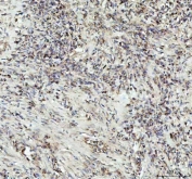 G-CSF Antibody Lung Squamous Tumor IHC. Immunohistochemistry of Granulocyte colony stimulating factor / CSF3 in FFPE human lung squamous cell carcinoma tissue using G-CSF antibody. HRP-DAB brown staining highlights cytoplasmic labeling in malignant squamous cells with a diffuse and heterogeneous distribution, along with staining in tumor-associated stromal cells, consistent with cytokine-related expression within the tumor microenvironment, while nuclei are counterstained blue. Heat induced epitope retrieval was performed by boiling tissue sections in pH 8 EDTA for 20 min followed by cooling prior to staining.