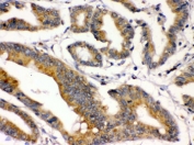 BMP2 Antibody Human Intestinal Cancer IHC. Immunohistochemistry staining of FFPE human intestinal cancer tissue using BMP2 Antibody / Osteogenic Growth Factor Antibody demonstrates moderate to strong cytoplasmic and membranous HRP-DAB brown staining within malignant epithelial cell populations forming glandular structures. The staining pattern is consistent with expression of Bone Morphogenetic Protein 2 (BMP2), a member of the TGF-beta superfamily that regulates cellular differentiation, tissue morphogenesis, growth factor signaling, and developmental pathways. Expression within tumor-associated epithelial cells is consistent with the established involvement of BMP signaling in epithelial biology, tissue remodeling, and regulation of cellular growth and differentiation. HIER: boil paraffin sections in pH 6, 10 mM citrate buffer for 20 minutes and allow to cool prior to staining.
