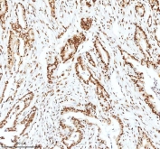 Ku70 Antibody Pancreatic Ductal Adenocarcinoma IHC. Immunohistochemistry analysis of FFPE human pancreatic ductal adenocarcinoma tissue stained with Ku70 Antibody demonstrates strong predominantly nuclear HRP-DAB brown staining throughout malignant gland-forming epithelial tumor cell populations, consistent with XRCC6 / Ku70-associated DNA damage response pathway expression. This DNA end binding protein antibody highlights non-homologous end joining-associated repair signaling and genomic stability regulation within pancreatic carcinoma tissue. HIER: boil tissue sections in pH8 EDTA for 20 min and allow to cool before testing.