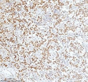 Ku70 Antibody Testicular Seminoma IHC. Immunohistochemistry analysis of FFPE human testicular seminoma tissue stained with Ku70 Antibody demonstrates strong diffuse nuclear HRP-DAB brown staining throughout neoplastic germ cell-associated tumor populations, consistent with XRCC6 / Ku70-associated DNA damage response pathway expression. This DNA end binding protein antibody highlights non-homologous end joining-associated repair signaling and genomic stability regulation within seminoma tissue. HIER: boil tissue sections in pH8 EDTA for 20 min and allow to cool before testing.