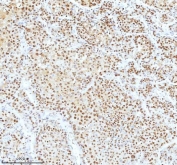 Ku70 Antibody Liver Cancer IHC. Immunohistochemistry analysis of FFPE human liver cancer tissue stained with Ku70 Antibody demonstrates strong diffuse nuclear HRP-DAB brown staining throughout malignant hepatic tumor cell populations, consistent with XRCC6 / Ku70-associated DNA damage response pathway expression. This DNA end binding protein antibody highlights non-homologous end joining-associated repair signaling and genomic stability regulation within hepatocellular carcinoma-associated tissue compartments. HIER: boil tissue sections in pH8 EDTA for 20 min and allow to cool before testing.