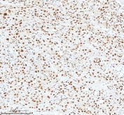 Ku70 Antibody Bladder Cancer IHC. Immunohistochemistry analysis of FFPE human bladder cancer tissue stained with Ku70 Antibody demonstrates strong predominantly nuclear HRP-DAB brown staining throughout malignant urothelial-associated tumor cell populations, consistent with XRCC6 / Ku70-associated DNA damage response pathway expression. This DNA end binding protein antibody highlights non-homologous end joining-associated repair signaling and genomic stability regulation within bladder carcinoma tissue. HIER: boil tissue sections in pH8 EDTA for 20 min and allow to cool before testing.