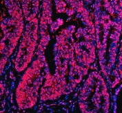 Ku70 Antibody Colon Cancer Immunofluorescence. Immunofluorescent analysis of FFPE human colon cancer tissue stained with Ku70 Antibody demonstrates strong nuclear and chromatin-associated red fluorescence throughout malignant gland-forming epithelial tumor cell populations, consistent with XRCC6 / Ku70-associated DNA damage response pathway localization. This DNA end binding protein antibody highlights non-homologous end joining-associated repair signaling and genomic stability regulation within colorectal carcinoma tissue. Nuclei are counterstained with DAPI nuclear stain (blue). HIER: steam section in pH8 EDTA buffer for 20 min.