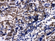 Ku80 Antibody Lung Cancer IHC. Immunohistochemistry analysis of human lung cancer tissue using Ku80 antibody. Formalin-fixed, paraffin-embedded sections show HRP-DAB brown nuclear staining in tumor epithelial cells, consistent with expression of Ku80 (XRCC5) in proliferative cell populations. The staining is enriched within densely cellular tumor regions, reflecting the role of Ku80 in coordinating DNA repair with cell cycle progression. Hematoxylin counterstain highlights nuclei (blue), providing contrast to the Ku80-positive nuclear signal and supporting its function in actively dividing cancer cells.