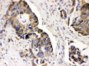 PDGFR Alpha Antibody Intestinal Cancer IHC. Immunohistochemistry staining of FFPE human intestinal cancer tissue using PDGFR Alpha Antibody / Receptor Tyrosine Kinase Antibody demonstrates cytoplasmic and membranous HRP-DAB brown staining within malignant gland-forming epithelial cells. The staining pattern is consistent with expression of PDGFRA, a receptor tyrosine kinase that mediates platelet-derived growth factor signaling and regulates cellular proliferation, migration, differentiation, and survival. PDGFRA has been implicated in tumor-associated growth factor signaling networks and contributes to cellular communication within the tumor microenvironment. The observed staining highlights PDGFRA expression in intestinal carcinoma-associated epithelial populations. HIER was performed by boiling tissue sections in pH 6, 10 mM citrate buffer for 20 minutes followed by cooling prior to immunostaining.