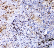 CD36 Antibody Human Lung Cancer IHC. Immunohistochemical staining of FFPE human lung cancer demonstrates CD36 expression using a CD36 antibody. CD36, also known as Fatty Acid Translocase, is a multifunctional scavenger receptor involved in long chain fatty acid uptake, lipid metabolism, and cellular energy homeostasis. Predominantly membranous and cytoplasmic staining is observed in tumor associated cells and subsets of malignant cells, consistent with the role of CD36 in metabolic reprogramming, inflammation, and tumor progression. Heat induced epitope retrieval was performed by boiling tissue sections in pH 6 10 mM citrate buffer for 20 minutes followed by cooling prior to staining. These results support the utility of CD36 Antibody for studies of cancer metabolism, lipid transport, scavenger receptor biology, and the tumor microenvironment.