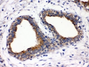 FUT1 Antibody Breast Cancer IHC. Immunohistochemistry staining of FFPE human breast cancer tissue using FUT1 Antibody demonstrates moderate to strong membranous and cytoplasmic HRP-DAB brown staining within malignant epithelial cells lining glandular and duct-like tumor structures. The staining pattern is consistent with expression of Fucosyltransferase 1 (FUT1), a Golgi-associated glycosyltransferase responsible for blood group H antigen biosynthesis and regulation of cell surface fucosylation. FUT1-mediated glycosylation influences cellular adhesion, receptor function, and cell-cell recognition processes, and altered expression has been associated with cancer-related changes in glycan composition and tumor cell behavior. The observed staining highlights neoplastic epithelial populations and is consistent with the known role of FUT1 in regulating biologically active cell surface carbohydrate structures. HIER: boil paraffin sections in pH 6, 10 mM citrate buffer for 20 minutes and allow to cool prior to staining.
