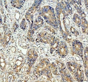 IHC staining of FFPE human stomach cancer tissue with CDC25B antibody. HIER: boil tissue sections in pH8 EDTA for 20 min and allow to cool before testing.