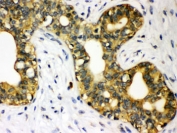 STAT1 Antibody Breast Cancer IHC. Immunohistochemistry staining of FFPE human breast cancer tissue using STAT1 antibody demonstrates strong cytoplasmic and membranous staining within neoplastic epithelial cells, consistent with expression of Signal Transducer and Activator of Transcription 1 (STAT1). STAT1 is a key transcription factor within the JAK-STAT signaling pathway that mediates cellular responses to interferons, cytokines, and growth factor-associated signaling networks. The observed staining pattern is consistent with the role of STAT1 in regulating transcriptional programs involved in immune responses, cellular differentiation, signal transduction, and tumor-associated signaling pathways. These findings support the utility of STAT1 antibody for studies of cytokine signaling, transcription factor biology, and cancer-related cellular regulation. HIER: boil paraffin sections in pH 6 10mM citrate buffer for 20 minutes and allow to cool prior to staining.