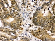 MKK3 Antibody / p38 MAP Kinase Kinase Antibody Human Intestinal Cancer IHC. Immunohistochemical staining of FFPE human intestinal cancer tissue using MKK3 Antibody / p38 MAP Kinase Kinase Antibody. MKK3 expression is detected predominantly within the cytoplasm of tumor cells, consistent with its role as a dual-specificity kinase that activates the p38 MAPK signaling pathway in response to inflammatory cytokines and cellular stress. Heat-induced epitope retrieval was performed by boiling tissue sections in pH 6.0 citrate buffer for 20 minutes followed by cooling before staining. Immunoreactivity supports the utility of this antibody for investigating stress-responsive signaling, inflammation, apoptosis, and cancer-associated p38 MAPK activation.