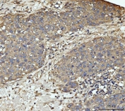 MKK3 Antibody / p38 MAP Kinase Kinase Antibody Human Liver Cancer IHC. Immunohistochemical staining of FFPE human liver cancer tissue using MKK3 Antibody / p38 MAP Kinase Kinase Antibody. MKK3 expression is detected predominantly within the cytoplasm of tumor cells, consistent with its role as a stress-responsive dual-specificity kinase that activates the p38 MAPK signaling pathway in response to inflammatory cytokines and cellular stress. Heat-induced epitope retrieval was performed in pH 8.0 EDTA buffer for 20 minutes followed by cooling before staining. This staining pattern supports the use of the antibody for investigating p38 MAPK signaling, inflammatory responses, apoptosis, and liver cancer biology.testing.
