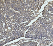 MKK3 Antibody / p38 MAP Kinase Kinase Antibody Human Ovarian Cancer IHC. Immunohistochemical staining of FFPE human ovarian cancer tissue using MKK3 Antibody / p38 MAP Kinase Kinase Antibody. MKK3 expression is detected predominantly within the cytoplasm of tumor cells, consistent with its function as a stress-responsive dual-specificity kinase that activates the p38 MAPK signaling pathway in response to inflammatory cytokines and environmental stress. Heat-induced epitope retrieval was performed in pH 8.0 EDTA buffer for 20 minutes followed by cooling before staining. This staining pattern demonstrates the utility of the antibody for investigating p38 MAPK signaling, inflammatory responses, apoptosis, and ovarian cancer biology.