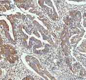 IHC staining of FFPE human colon cancer tissue with IDH2 antibody. HIER: boil tissue sections in pH8 EDTA for 20 min and allow to cool before testing.