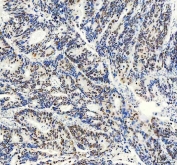 IHC staining of FFPE human colon cancer tissue with FOXA3 antibody. HIER: boil tissue sections in pH8 EDTA for 20 min and allow to cool before testing.