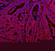 Immunofluorescent staining of FFPE human colon cancer tissue with RAB14 antibody (red) and DAPI nuclear stain (blue). HIER: steam section in pH8 EDTA buffer for 20 min.
