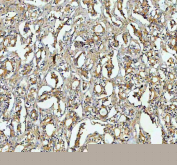 IHC staining of FFPE human ovarian cancer tissue with RAB14 antibody, HRP-labeled secondary and DAB substrate. HIER: boil tissue sections in pH8 EDTA for 20 min and allow to cool before testing.