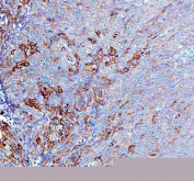 IHC staining of FFPE human non-keratotic squamous cell carcinoma of the cervix tissue with RAB14 antibody, HRP-labeled secondary and DAB substrate. HIER: boil tissue sections in pH8 EDTA for 20 min and allow to cool before testing.