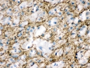 MUNC18-1 Antibody Human Glioma IHC. Immunohistochemical staining of FFPE human glioma tissue with MUNC18-1 antibody. Heat-induced epitope retrieval (HIER) was performed by boiling tissue sections in pH 6, 10 mM citrate buffer for 20 minutes and allowing them to cool prior to staining. Strong MUNC18-1 immunoreactivity is observed predominantly within the cytoplasm and along the cell membranes of glioma cells, consistent with the expected intracellular localization of STXBP1. Cell nuclei are counterstained with hematoxylin (blue).
