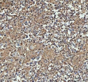 IHC staining of FFPE human testicular germ cell tumor tissue with Actin antibody. HIER: Boil the paraffin sections in pH8 EDTA buffer for 20 minutes and allow to cool prior to staining.