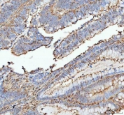 IHC staining of FFPE human colorectal adenocarcinoma tissue with anti-Actin antibody. HIER: boil tissue sections in pH8 EDTA for 20 min and allow to cool before testing.