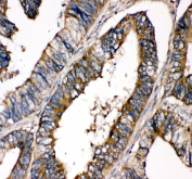 Immunohistochemical staining of FFPE human colon cancer tissue with SHP-2 antibody, HRP-secondary and DAB substrate. HIER: boil tissue sections in pH8 EDTA for 20 min and allow to cool before testing.