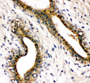 Immunohistochemical staining of FFPE human breast cancer tissue with SHP-2 antibody, HRP-secondary and DAB substrate. HIER: boil tissue sections in pH8 EDTA for 20 min and allow to cool before testing.
