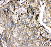 Immunohistochemical staining of FFPE human lung cancer tissue with SHP-2 antibody, HRP-secondary and DAB substrate. HIER: boil tissue sections in pH8 EDTA for 20 min and allow to cool before testing.