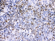 IKZF1 Antibody Human Tonsil IHC. Immunohistochemical staining of FFPE human tonsil tissue using IKZF1 Antibody / Lymphoid Development Transcription Factor Antibody demonstrates prominent nuclear HRP-DAB brown staining within subsets of lymphoid cells. The staining pattern is consistent with expression of IKZF1 (Ikaros), a master regulator of lymphoid lineage commitment that controls gene expression programs required for lymphocyte differentiation, immune cell maturation, and hematopoietic development. Strong nuclear localization is expected for this DNA-binding transcription factor and highlights its central role in regulating the formation and maintenance of lymphoid cell populations. These findings support the utility of this antibody for immunohistochemical detection of endogenous IKZF1 in lymphoid tissues. HIER: boil paraffin sections in pH 6, 10mM citrate buffer for 20 min and allow to cool prior to staining.