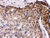 IRF5 Antibody Human Breast Cancer IHC. Immunohistochemistry was performed on FFPE human breast cancer tissue using IRF5 Antibody. Heat-induced epitope retrieval was performed by boiling tissue sections in pH 6, 10 mM citrate buffer for 20 minutes followed by cooling prior to incubation with the primary antibody. Bound antibody was visualized using an HRP-conjugated secondary antibody and DAB chromogen. Predominantly nuclear staining is observed in the malignant epithelial cells, consistent with the role of IRF5 as an immune response-regulating transcription factor. These results demonstrate that this Immune Response Regulator Antibody is suitable for immunohistochemical detection of IRF5 in formalin-fixed, paraffin-embedded human breast cancer tissue.