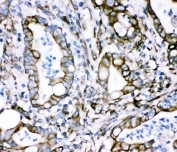 Plectin Antibody Intestinal Cancer IHC. Immunohistochemical staining of FFPE human intestinal cancer demonstrates plectin expression using a Plectin antibody. Plectin is a large cytolinker protein that connects intermediate filaments with membrane associated complexes to maintain cellular architecture and mechanical stability. Strong membranous and cytoplasmic staining is observed in malignant glandular epithelial cells, consistent with the elevated expression and altered cytoskeletal organization associated with tumor progression. Heat induced epitope retrieval was performed by boiling paraffin sections in pH 8 EDTA buffer for 20 minutes followed by cooling prior to staining. These results support the utility of Plectin Antibody for studies of cell adhesion, cytoskeletal dynamics, and cancer biology.