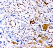Plectin Antibody Lung Cancer IHC. Immunohistochemical staining of FFPE human lung cancer demonstrates plectin expression using a Plectin antibody. Plectin is a multifunctional cytolinker protein that stabilizes intermediate filaments and anchors cytoskeletal networks to membrane associated complexes. Heterogeneous cytoplasmic and membranous staining is observed in subsets of malignant cells and tumor associated structures, consistent with the dynamic changes in cellular architecture and adhesion that accompany cancer progression. Heat induced epitope retrieval was performed by boiling paraffin sections in pH 8 EDTA buffer for 20 minutes followed by cooling prior to staining. These findings support the utility of Plectin Antibody for investigations of cytoskeletal organization, mechanotransduction, and tumor biology.