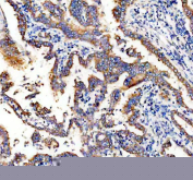 IHC analysis of STING/TMEM173 Antibody. STING expression was examined in a paraffin-embedded section of human lung cancer tissue. Following heat-mediated antigen retrieval in EDTA buffer (pH 8.0), sections were blocked with goat serum and incubated with a rabbit anti-STING/TMEM173 antibody. Immunoreactivity was visualized using an HRP-based detection system with DAB chromogen. STING staining is observed predominantly in tumor epithelial cells with cytoplasmic and membranous localization patterns, while surrounding stromal areas show lower background signal.