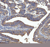 Immunohistochemical staining of FFPE human rectal cancer tissue with Smac antibody, HRP-secondary and DAB substrate. HIER: boil tissue sections in pH8 EDTA for 20 min and allow to cool before testing.