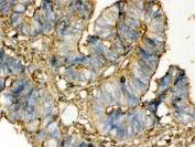 IHC-P: TGM2 antibody testing of human intestine cancer